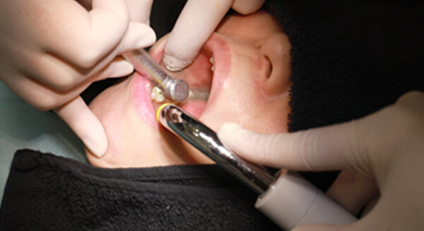 銀歯を除去する治療の様子