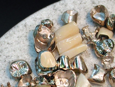 金属の歯