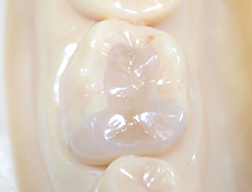セラミックの特徴②二次虫歯予防になる