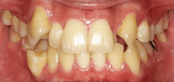 食べ物の色が歯に染み込んでいることによる黄ばみ