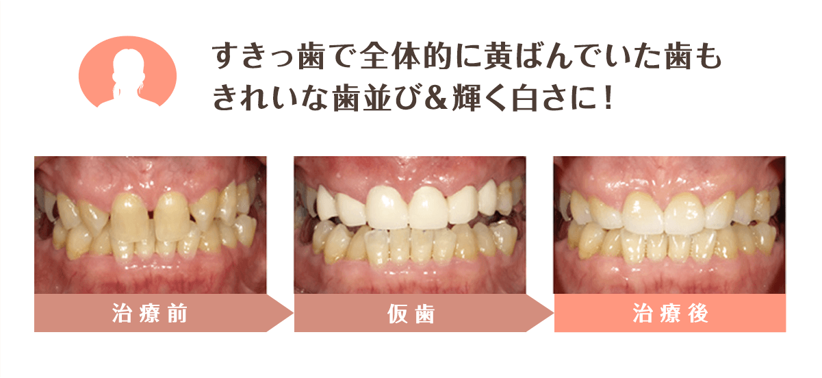 変形しないため二次虫歯予防になる