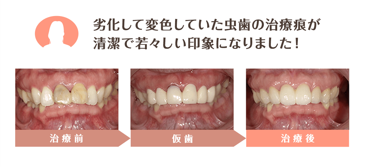 変形しないため二次虫歯予防になる