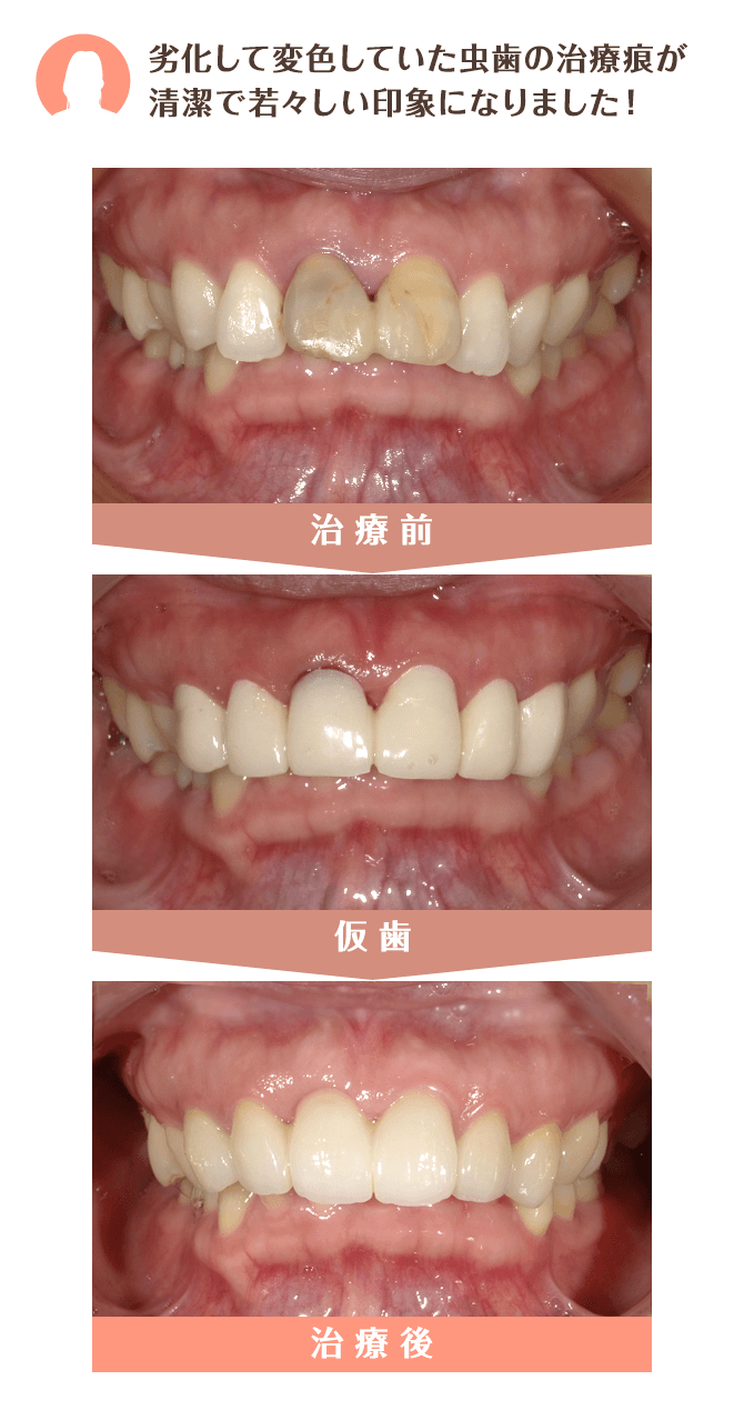 変形しないため二次虫歯予防になる