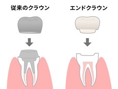 エンドクラウン