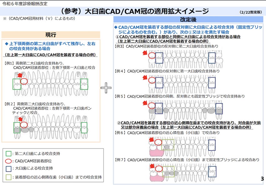 大臼歯CAD/CAM冠の適用拡大イメージ