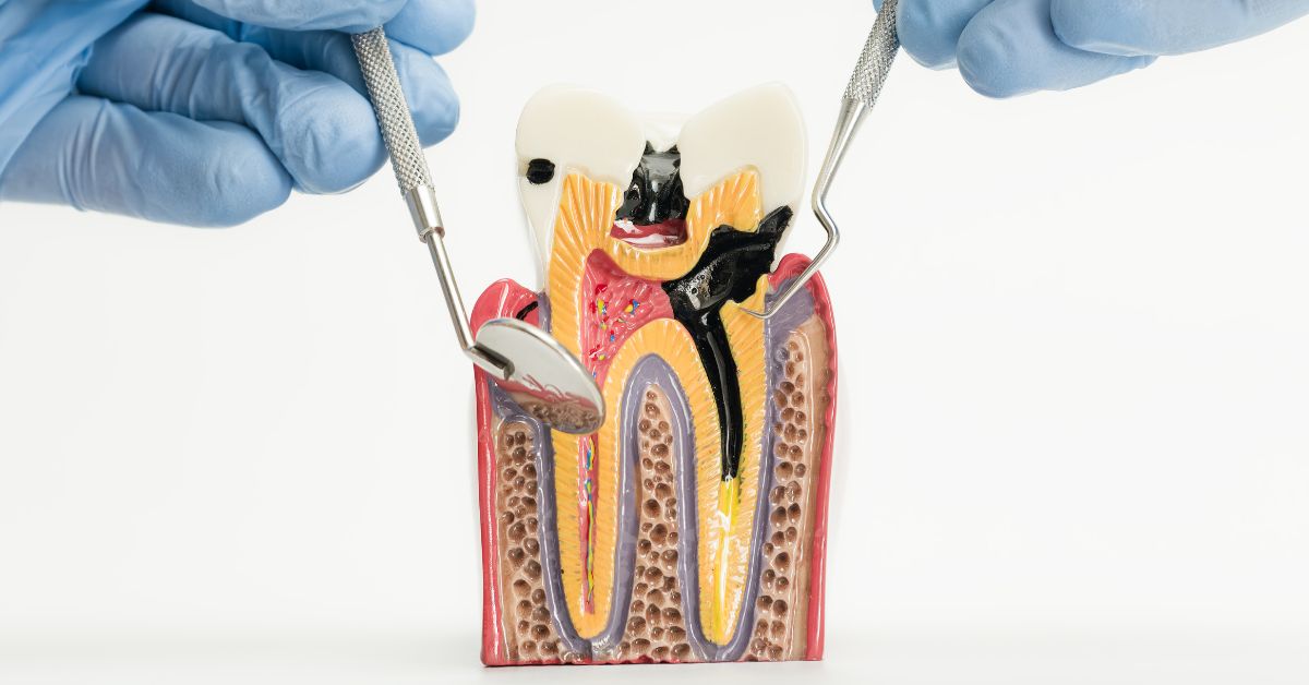 ②虫歯や歯周病が進行している人