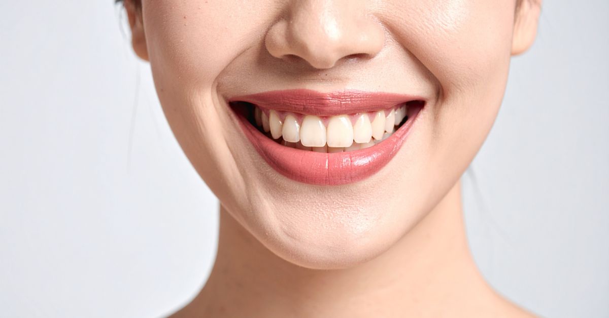 ラミネートベニアがおすすめな人のチェックリスト5選