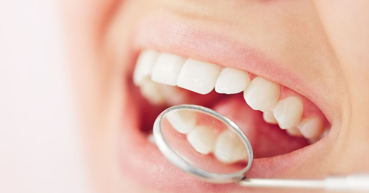 ④軽度の歯並び（ねじれ・段差）を治したい人