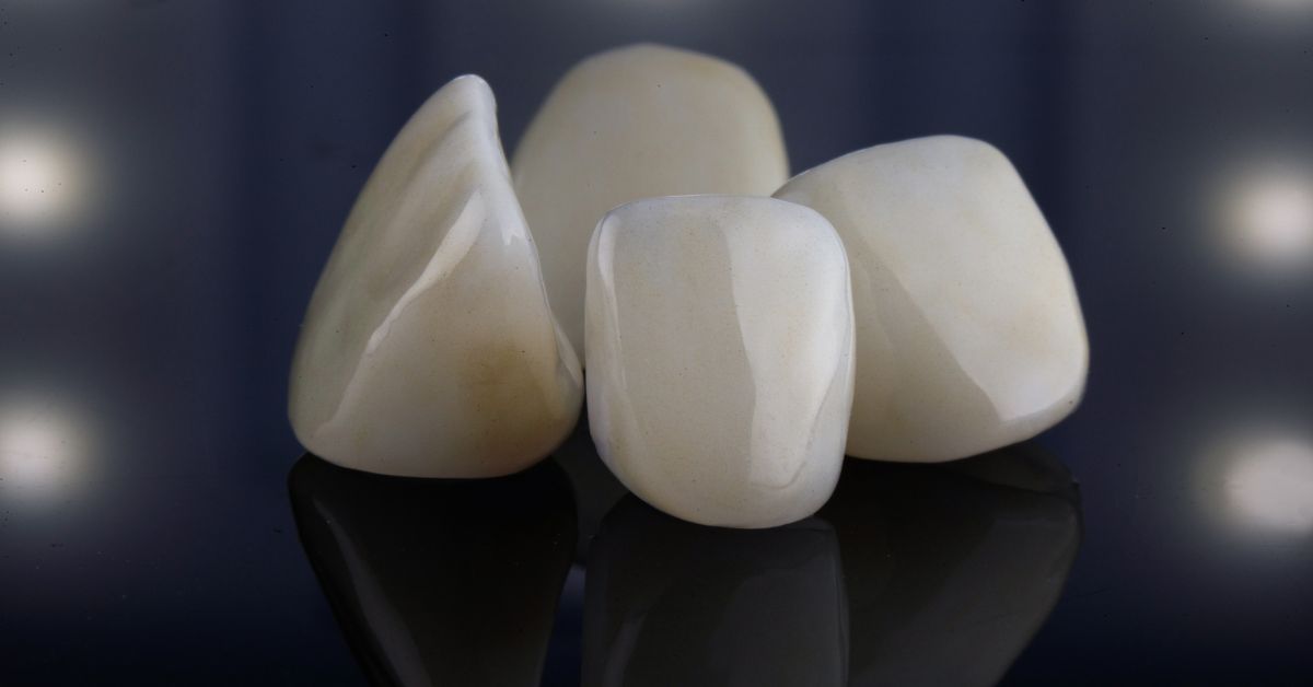 逆にラミネートベニアがおすすめできない人は？断られるケースと対策