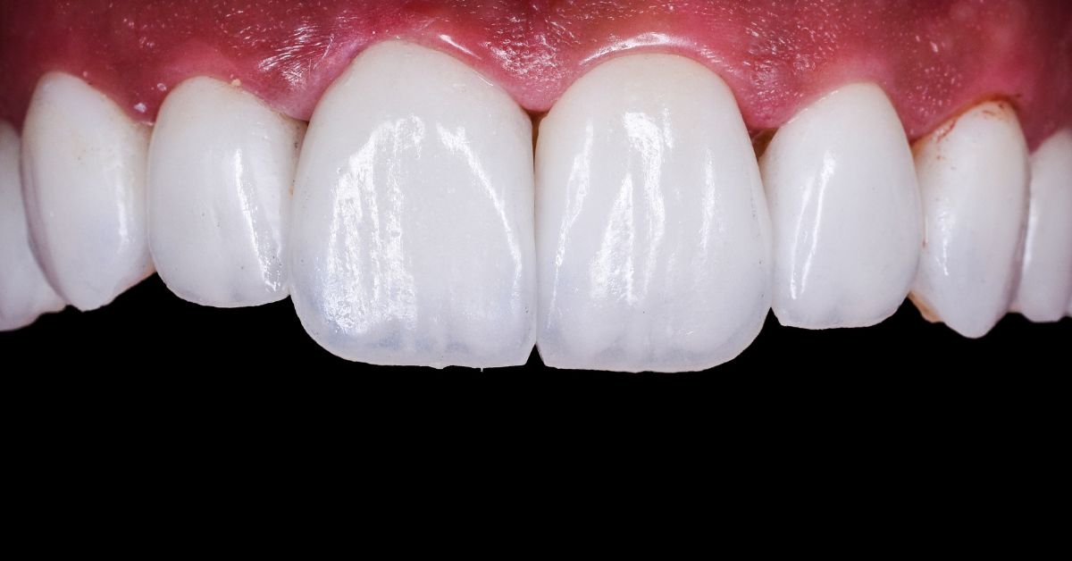 あなたはどっち?「e-max&ジルコニア」の選定基準